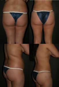 A procedure to lift and shape sagging buttox