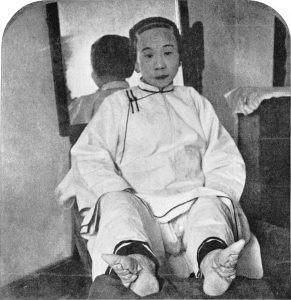 Chinese women with lotus feet (foot binding)